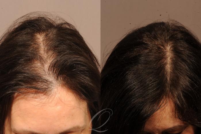 FUT Hair Transplant Before and After