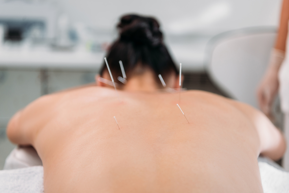 acupuncture for stress and anxiety near me